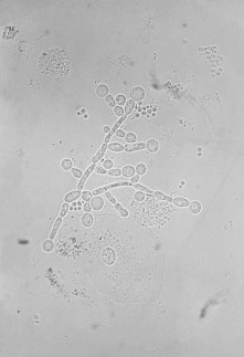 Candida_albicans_(sputum)
